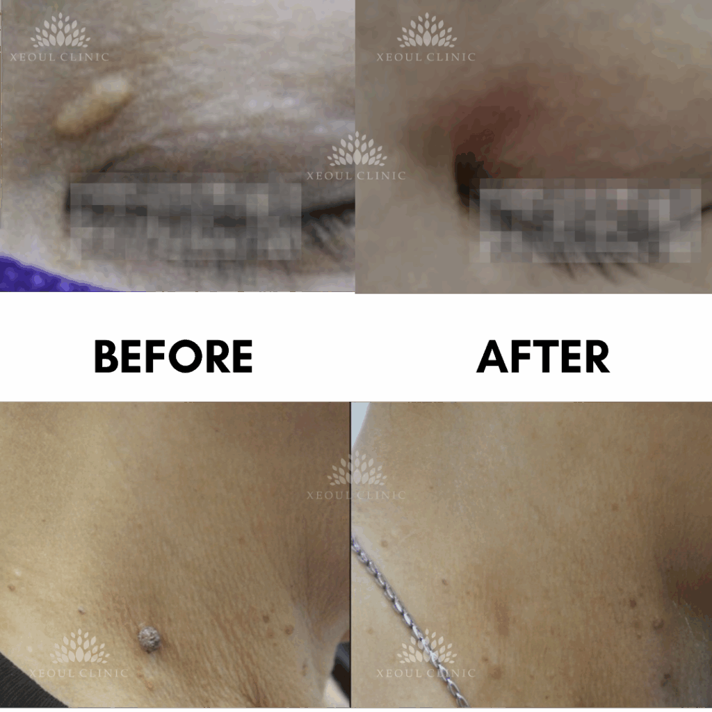 photo showing co2 ablative laser to remove mole on neck and xanthelasma fats on eyelid without scar