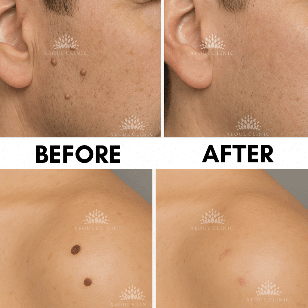photo showing mole removal on shoulder and skin tag on male cheeks with co2 laser to remove unwanted lesion