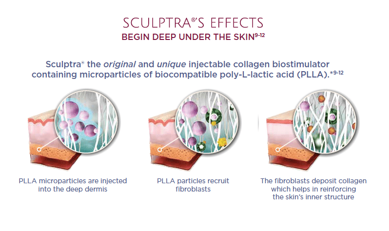 sculptra effect display how skin work from collagen biostimulator containing microparticles of biocompatible poly-L-lactic acid (PLLA).