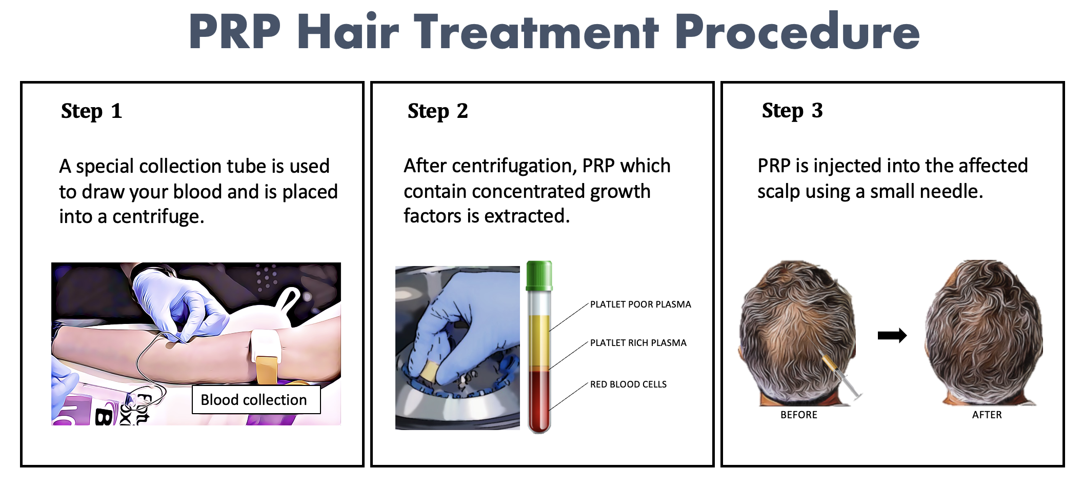 PRP Hair Loss Treatment – Xeoul Clinic