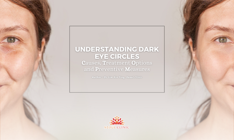 Understanding Dark Eye Circles: causes, treatments and preventive ...