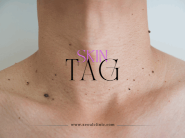 Everything You Need to Know About Skin Tags