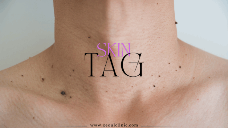 Everything You Need to Know About Skin Tags