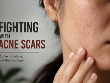 Fighting with acne scars