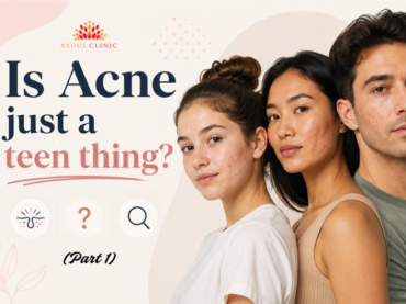 Is Acne just a teen thing?