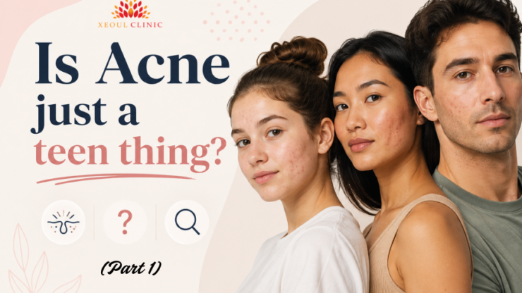 Is Acne just a teen thing?